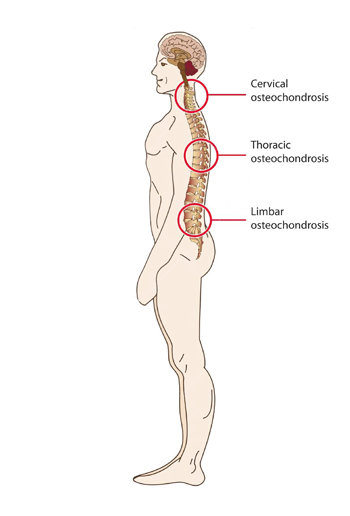 kaklo stuburo osteochondrozė ir hipertenzija